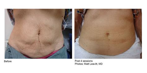 velashape valencia|VelaShape III para eliminar la Piel de Naranja.